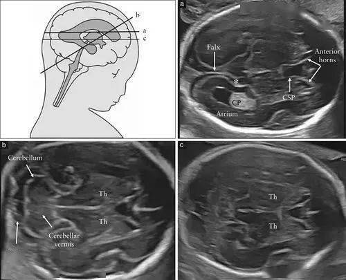 头部检查平面为经侧脑室(图2a)和经小脑(图2b)的两个头部横切面;经