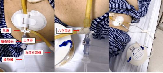 吻合口瘘了利用身边好物帮你完成腹腔冲洗