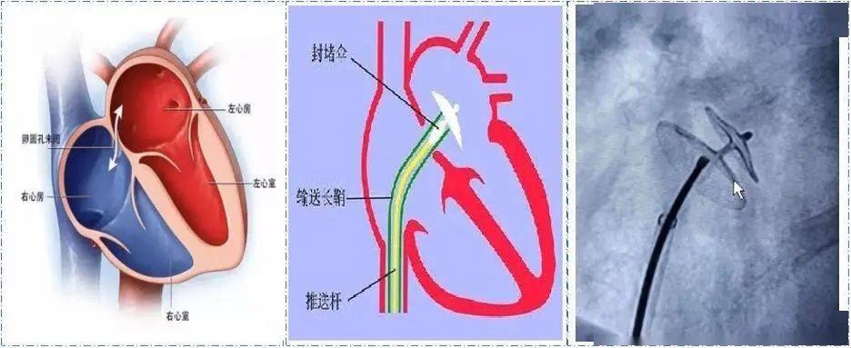 附脐静脉解剖位置图片