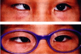 全国爱眼日对眼是斜视吗不同情况治疗方式大不同
