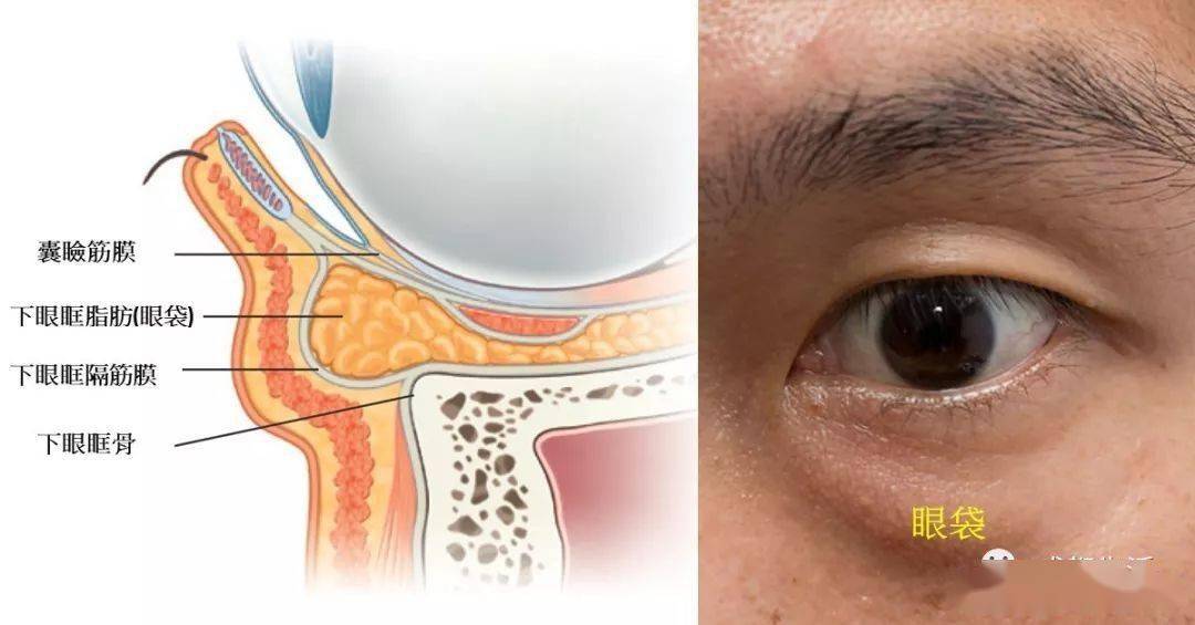 特别是从侧面看 凸起很明显 格外显老 泪沟是眼眶隔膜下缘形成的凹陷