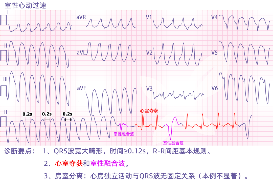 机械分离心电图图片