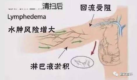 因为血流的增加必定使淋巴液的产生增加,从而使淋巴循环负担加重