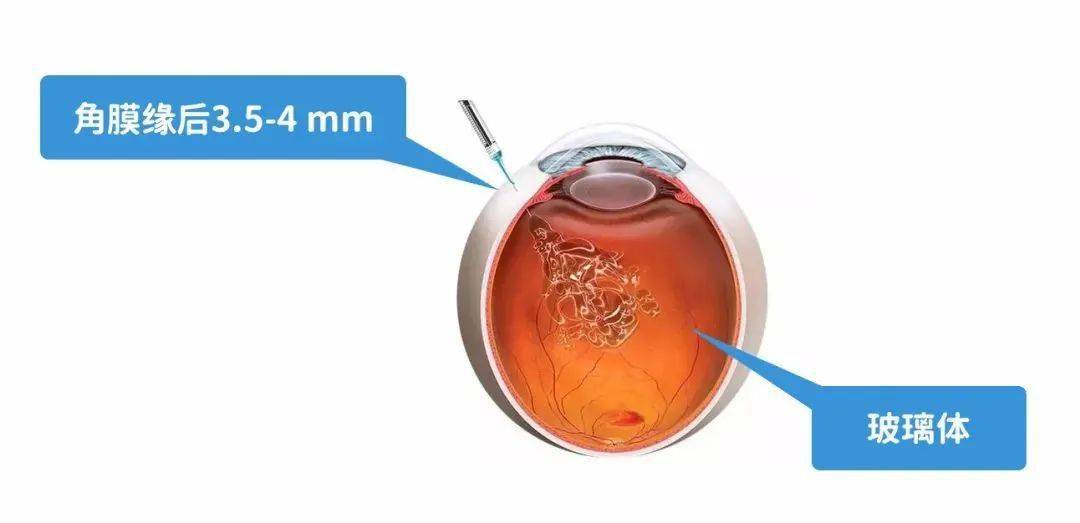 通过专用的注射针头,将药物注射至玻璃体腔内,通过向视网膜组织输送