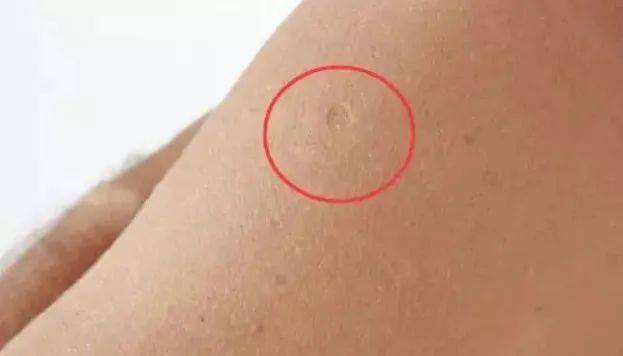 牛痘疫苗疤痕手臂图片