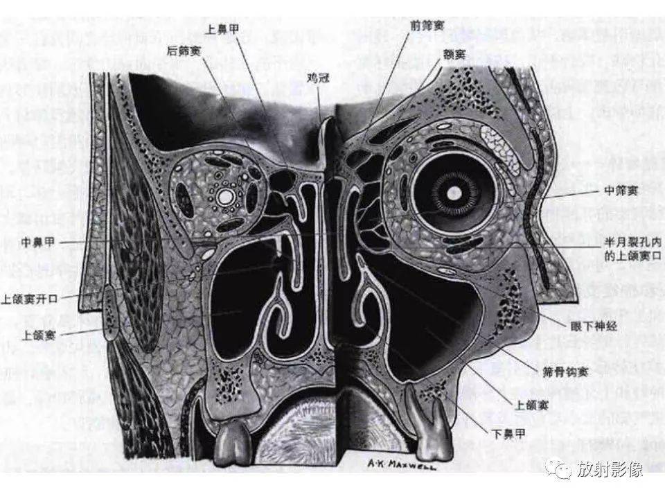 写鼻窦报告千万要注意这个解剖结构_病变_邢振_平台