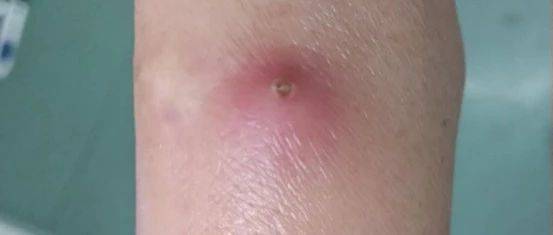 留置针拔除后针眼感染化脓，罪魁祸首竟然是这个！_患者_时间_静脉