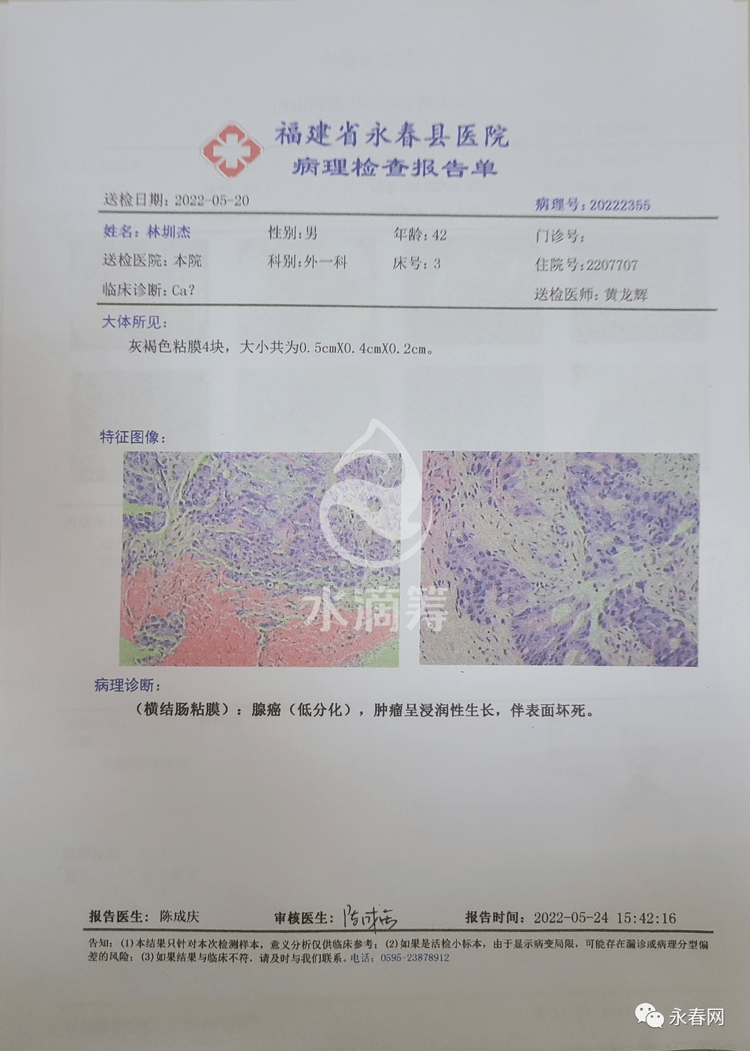 肺癌病理诊断报告单图片