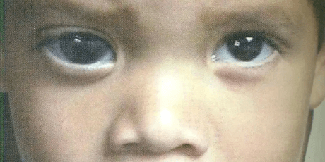 婴儿青光眼图片图片