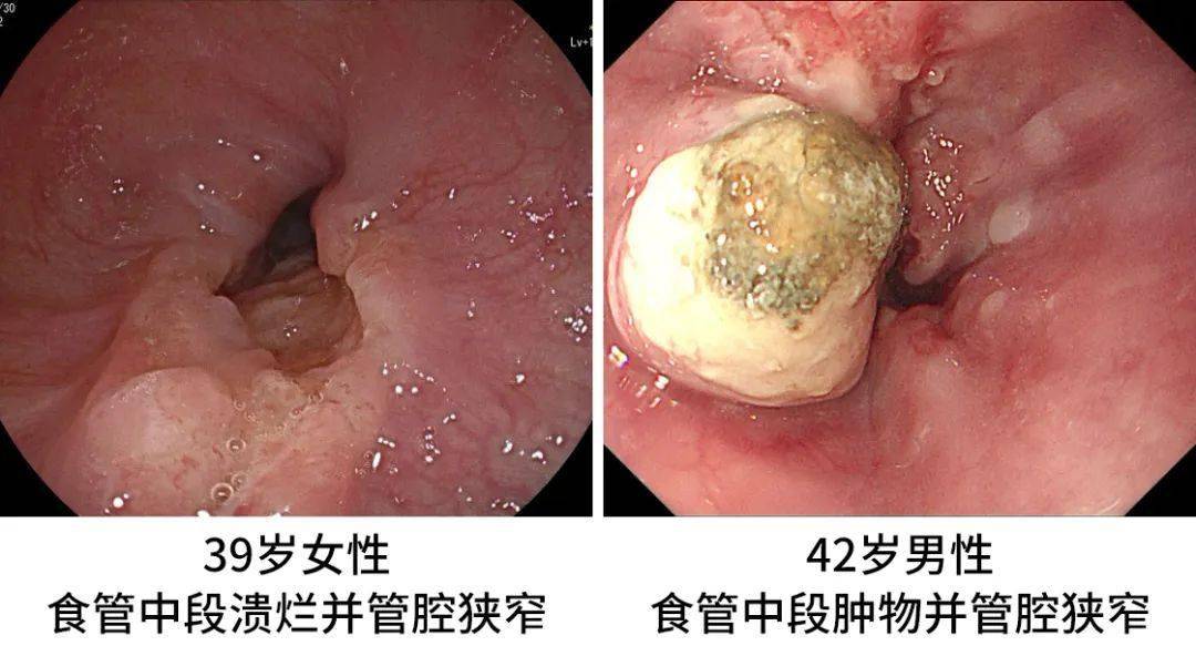 如果到晚期才发现