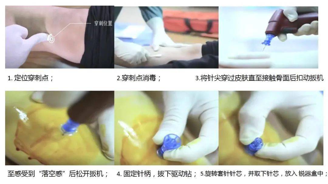 【ppt】永不塌陷的生命通路-骨髓腔输液技术_护理_微信_中卫