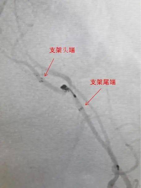 atlas病例集孙勇小径输送更远更细右侧胼周动脉分叉部微小动脉瘤支架