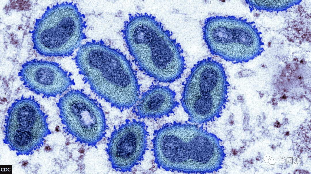 英国卫生安全局表示,由于猴痘病毒主要通过密切接触传播,因此猴痘病毒