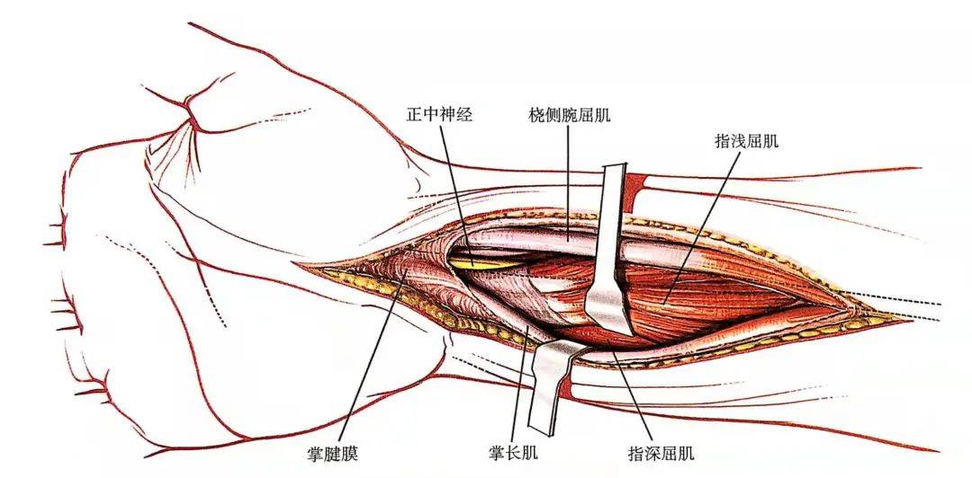 切開掌長肌和橈側腕屈肌間的前臂筋膜,顯露指淺屈肌及其肌腱正中