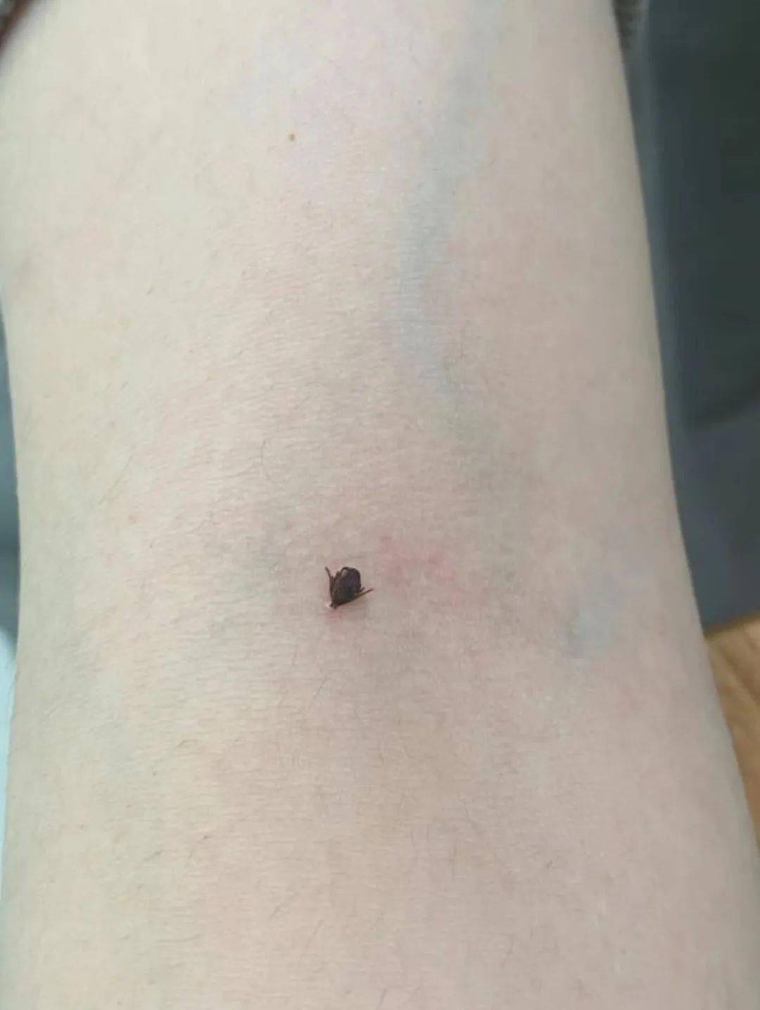 温州姑娘身上突然冒出小黑点检查后吓坏了