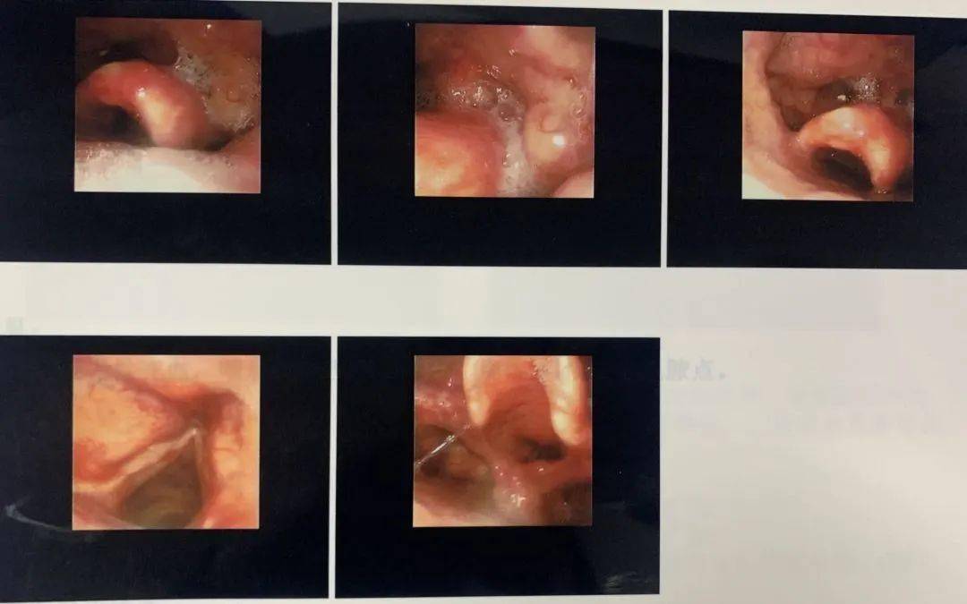 声带息肉术后图片