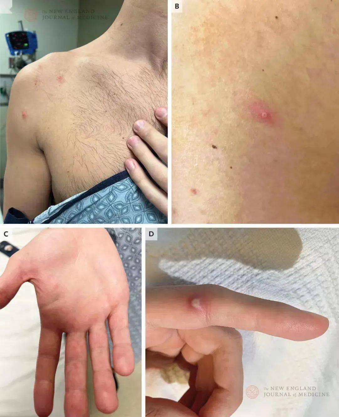 图 a 显示肛周溃疡,有触痛,直径不到 1 cm,边缘隆起,硬实.