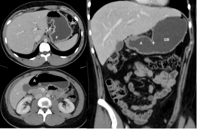 急性胃痛影像表现