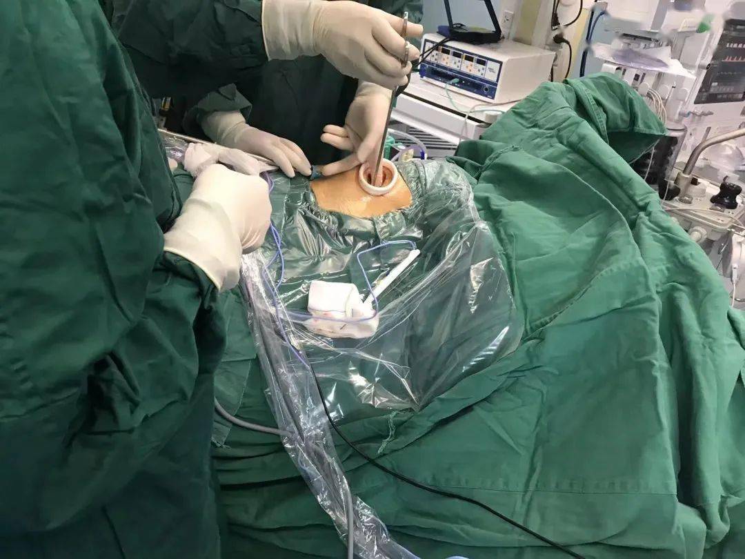 心胸外科成功实施一例高难度胸腔镜下左肺下叶切除术_患者_手术_病史