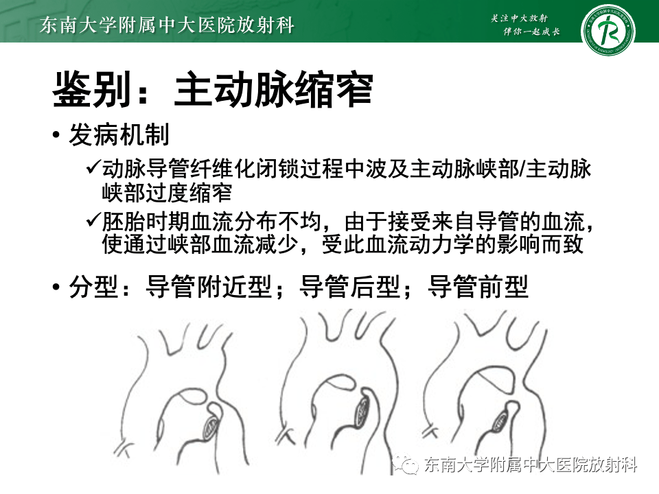 主动脉弓离断分型图片