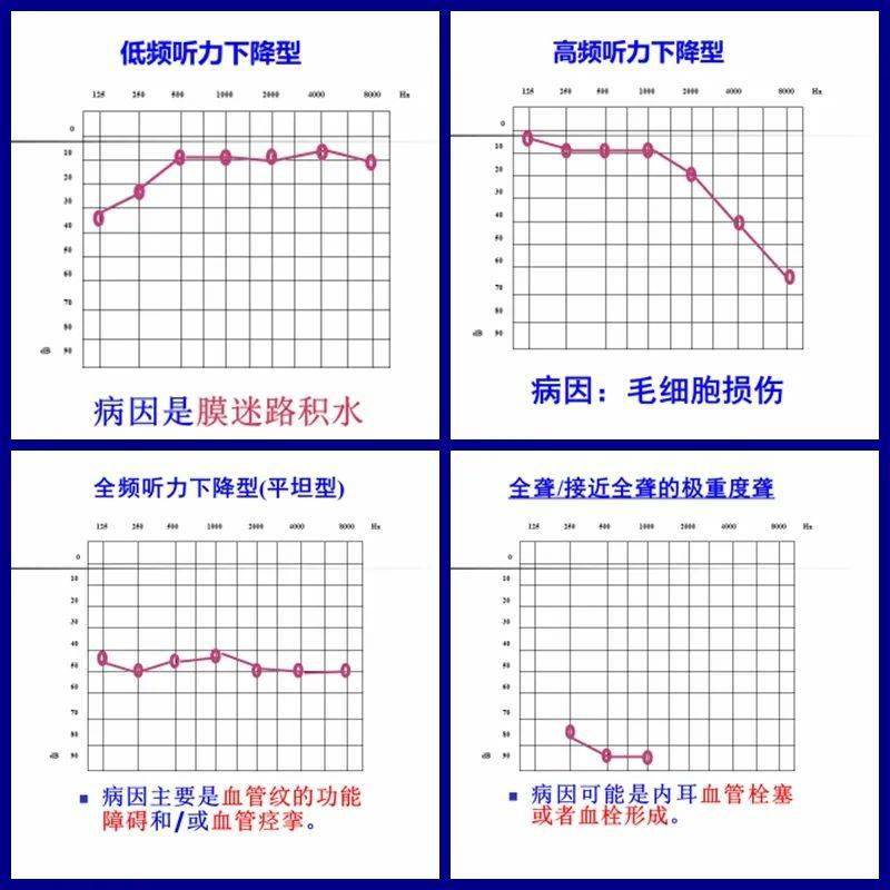 耳硬化症纯音测听图图片