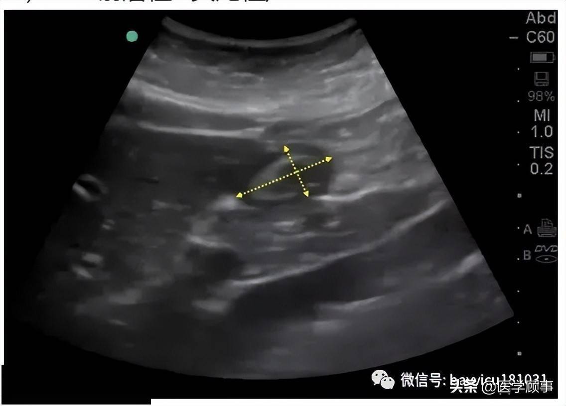 重症超声床边获得胃窦超声切面