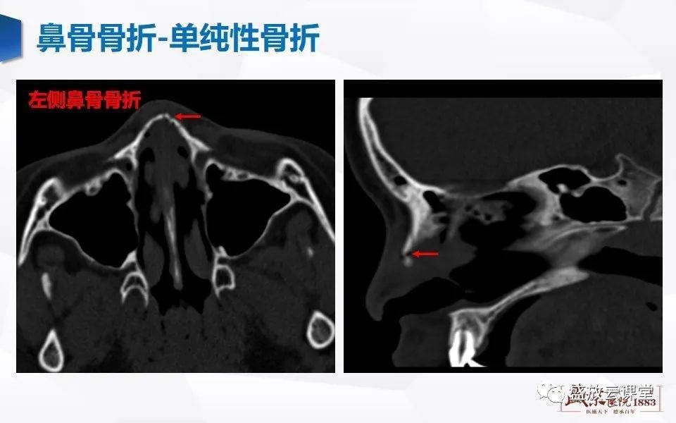 正常鼻子ct图片图片