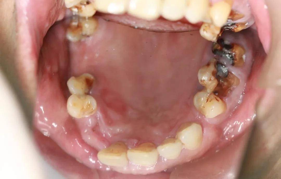 老掉牙都是什么原因造成的专家提醒缺牙不补害人不浅
