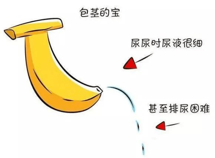 排尿时尿流细如线,排尿时可看到包皮鼓起,甚至发生排尿困难