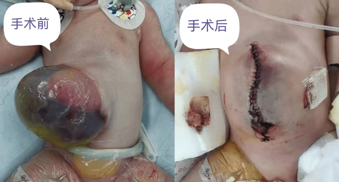医院母婴多学科门诊救回巨型脐膨出新生儿_小高_宝宝_韩冰