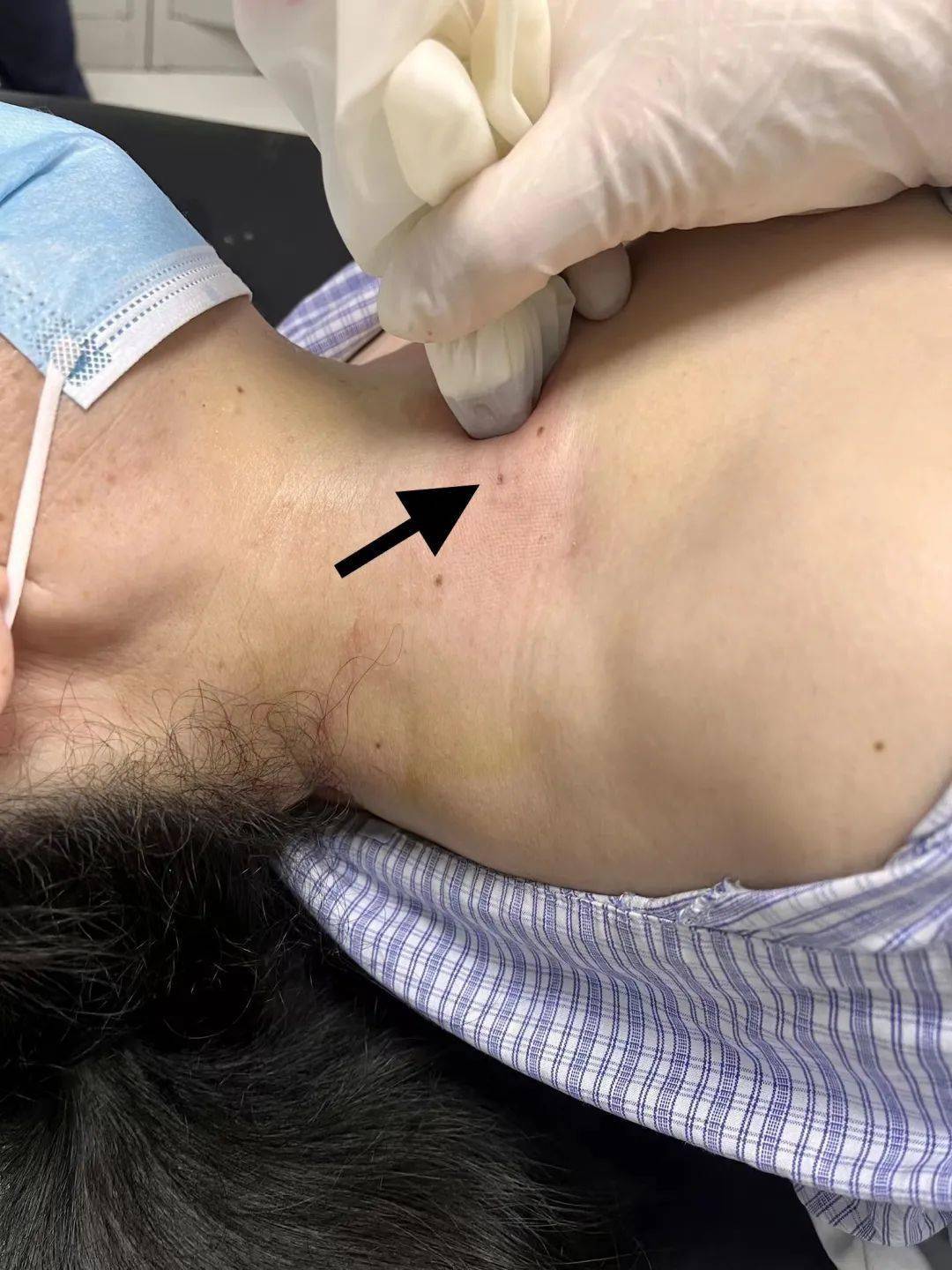 术后仅有的小针眼病理活检是淋巴结疾病诊断的金标准.