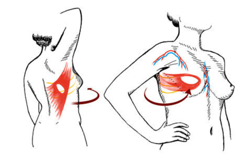 背阔肌皮瓣乳房重建术图片