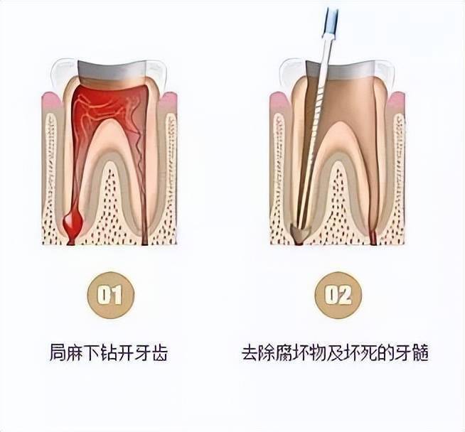 看牙避坑指南根管治療抽神經的那些事一次性和你嘮清楚