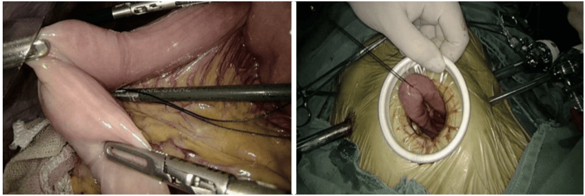 吻合(吻合器包皮环切手术)