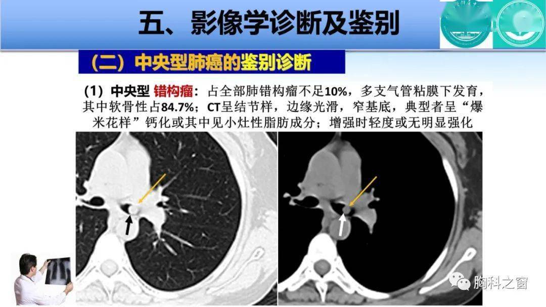 中央型肺癌的影像學表現及相關疾病鑑別診斷