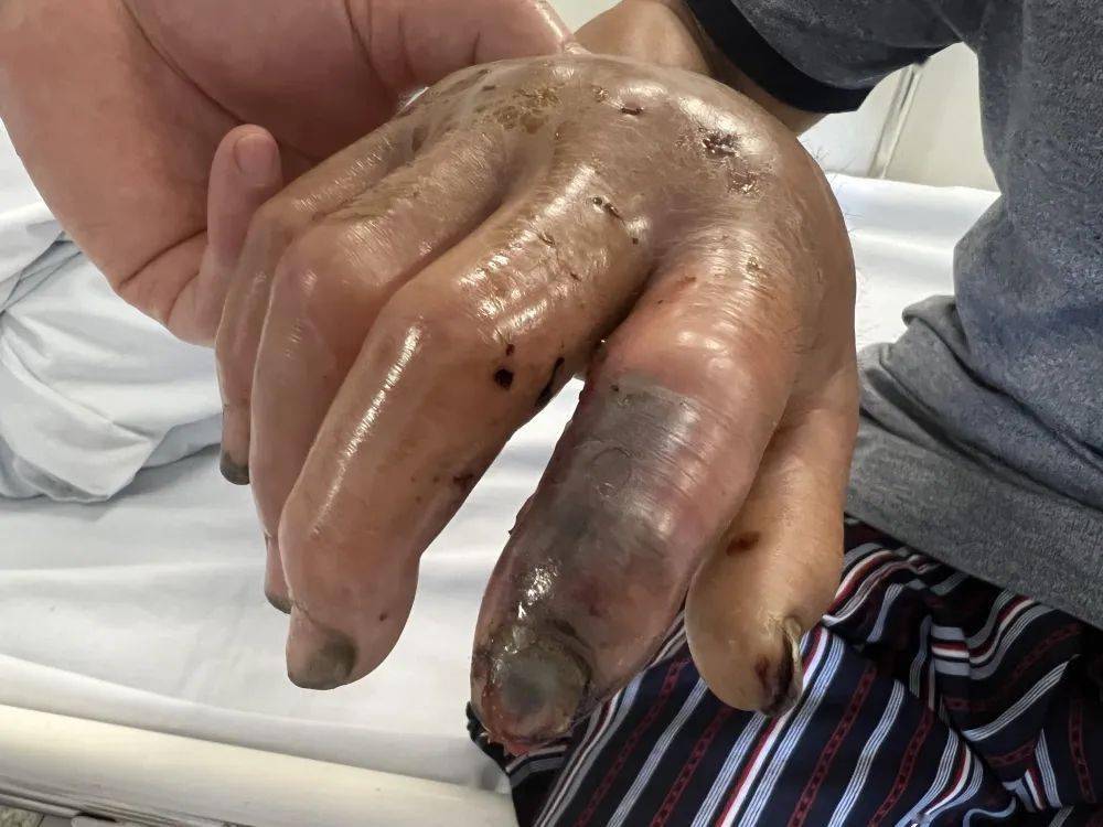 手指僵硬,无法伸直,握拳也很费劲右手食指已经发黑,右手背像个发面