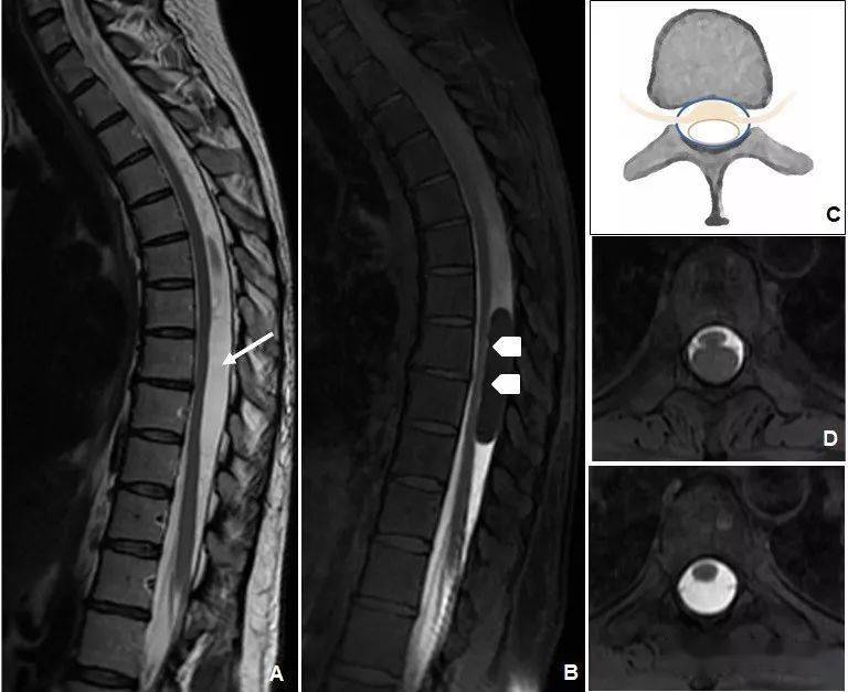 椎管内囊肿图片图片