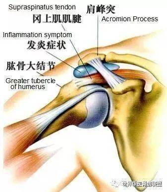 冈上肌肌腱炎治疗图片