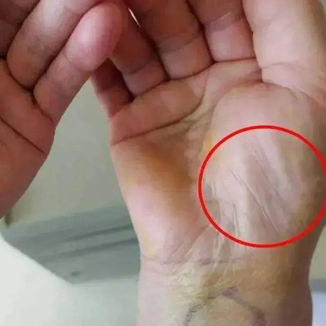 身体好不好,看手就知道!这几种大病从手上就能看出来,非常简单,人人都能看会!_手掌_手指_青筋