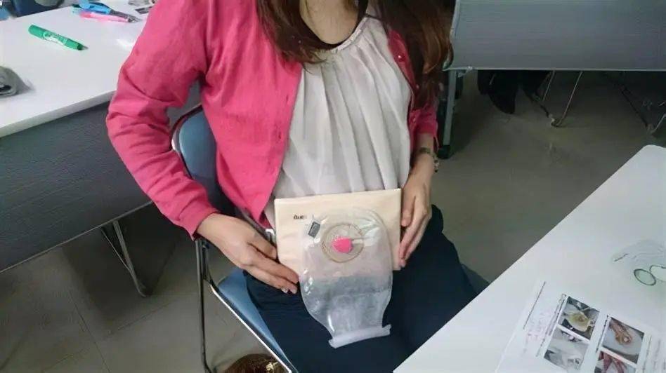 往往是将直肠和肛门"一刀切",再经腹部造瘘,在腹壁排便