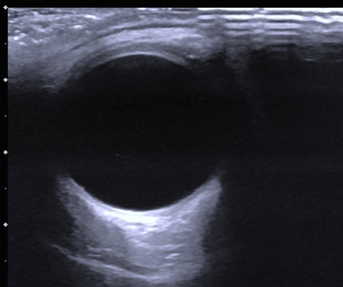 22mm玻璃体长度:16.50±0.25mm眼球壁