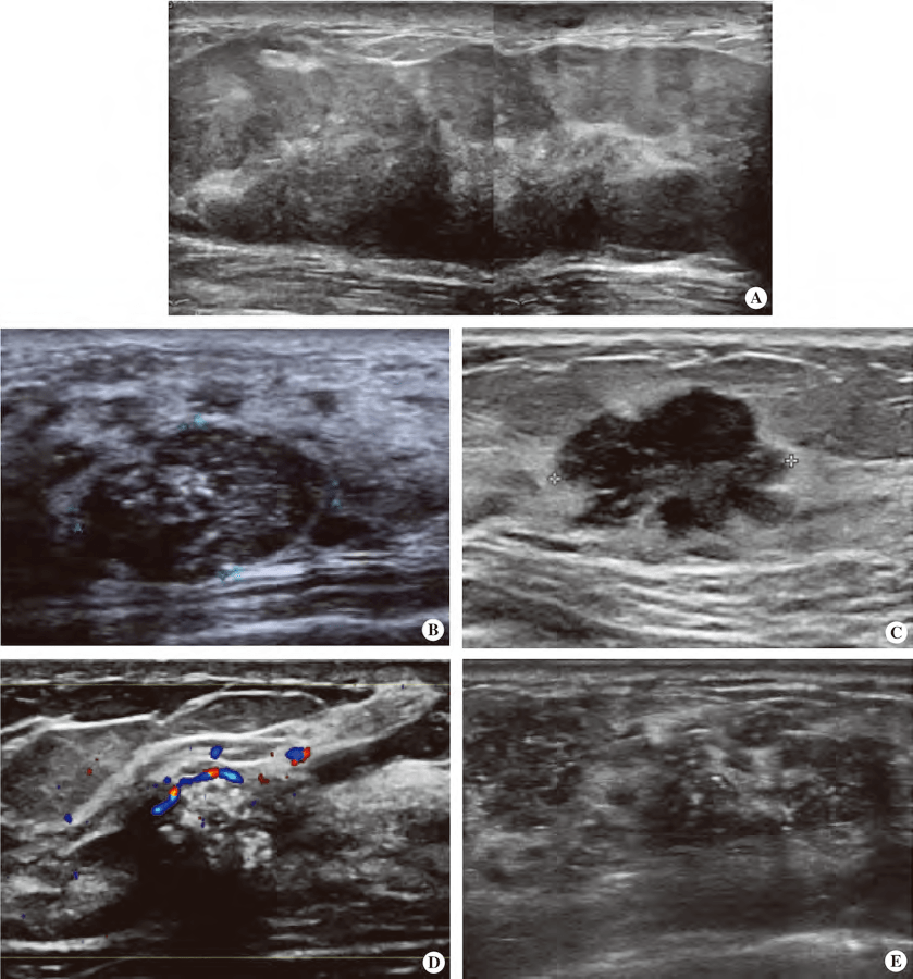 年轻乳腺癌典型病例超声诊断