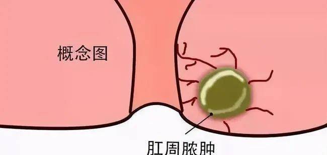 得了肛瘘就是肛门会漏吗