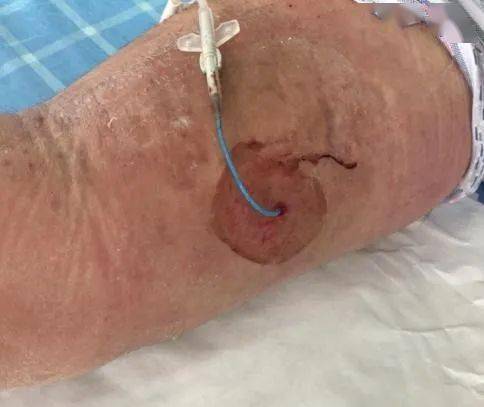 护士评估时发现 picc 穿刺点渗血伴红肿热痛,做了分泌物培养 血培养