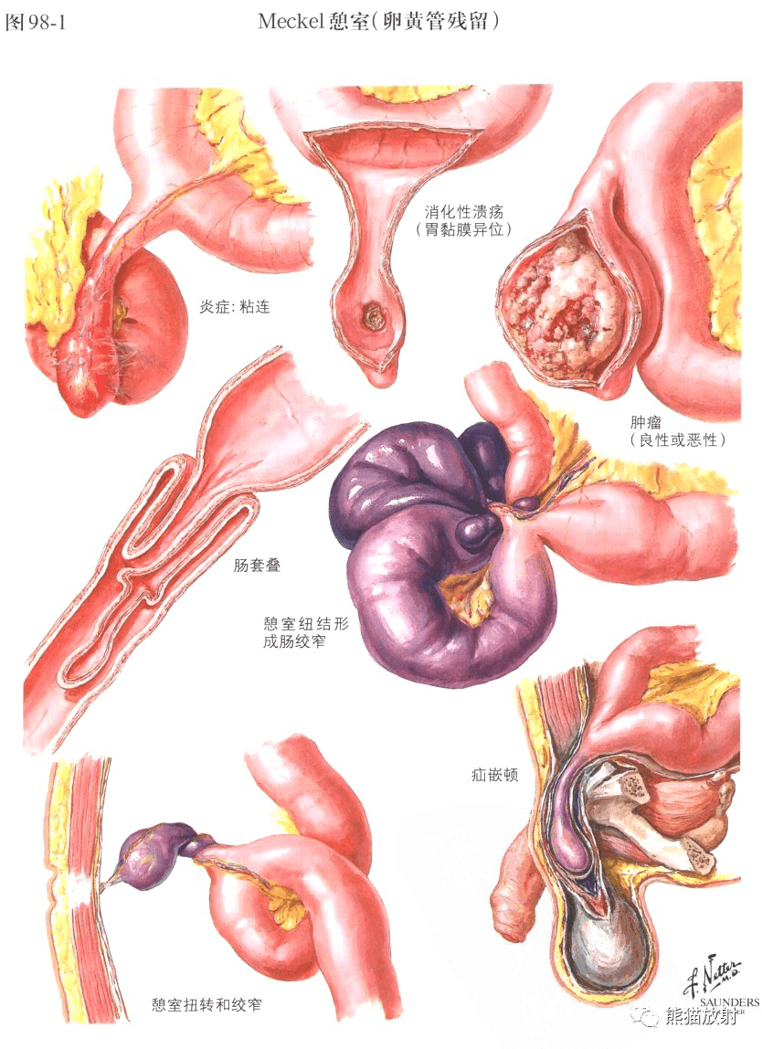 奈特图谱丨小肠解剖及相关疾病