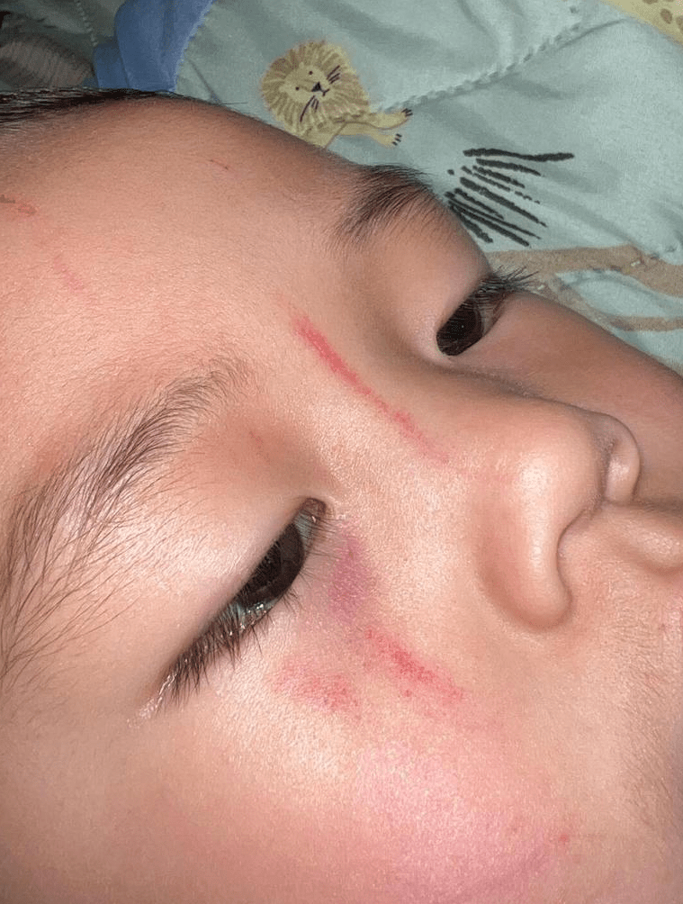 震惊只是在玩闹澳男童托儿中心被小朋友咬伤脸上布满抓痕家长怒批机构