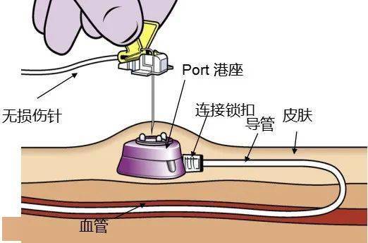 输液港植入术手术步骤图片