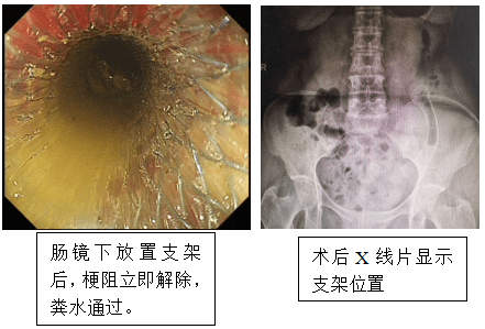 肠梗阻支架图片