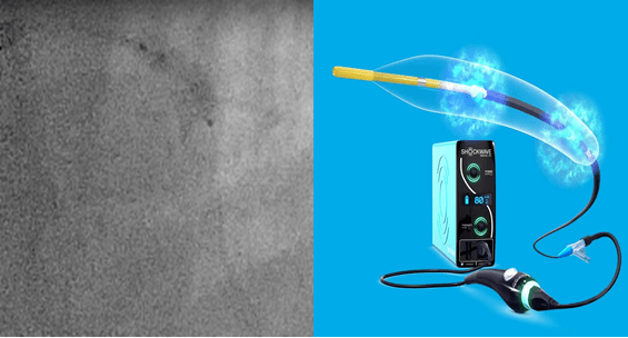 "shockwave ivl"血管内冲击波碎石技术治疗冠脉血管
