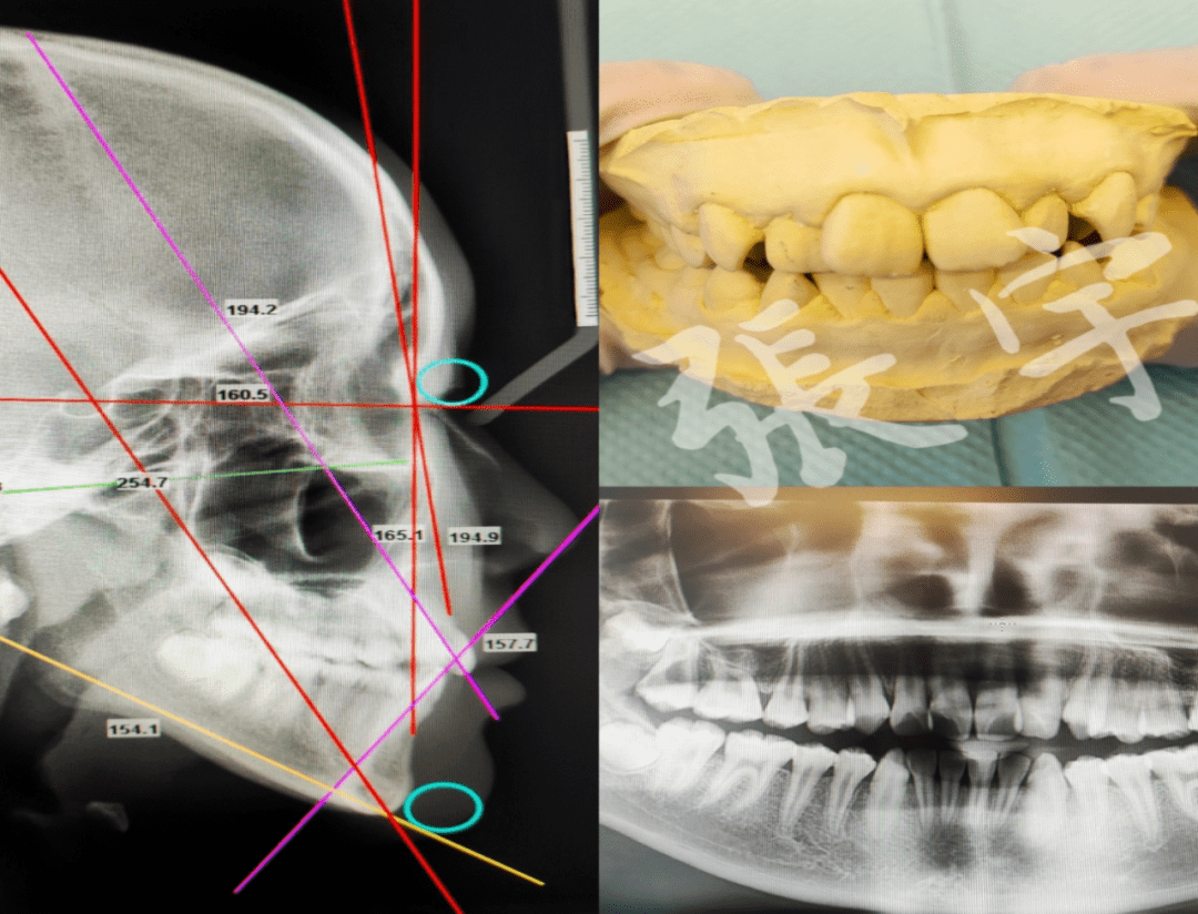 二是正畸前拍片取模测量分析:曲面断层片,头颅侧位片,石膏模型,口内